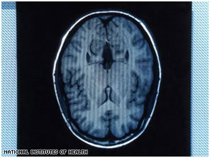 دواء الصرع قد يسبب انتانات دماغية مميتة Brain_cat